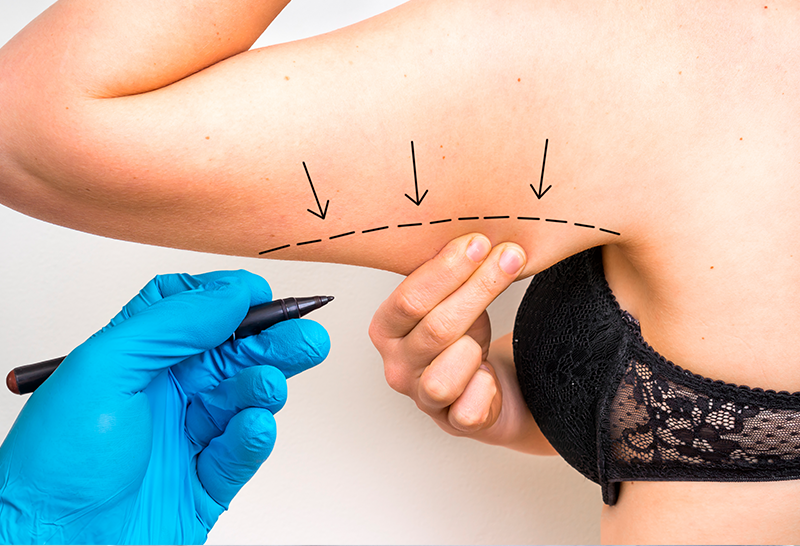 Arm Lift Surgery (Brachioplasty) and Arm Liposuction