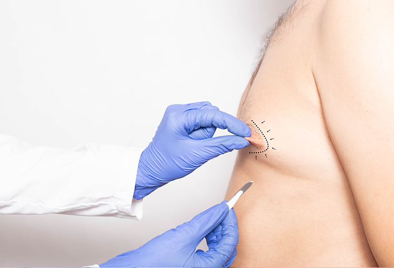 Correction of Breast Size in Men (Gynecomastia Surgery)