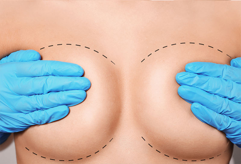 L’opération de réduction mammaire (Reduction Mamoplasty