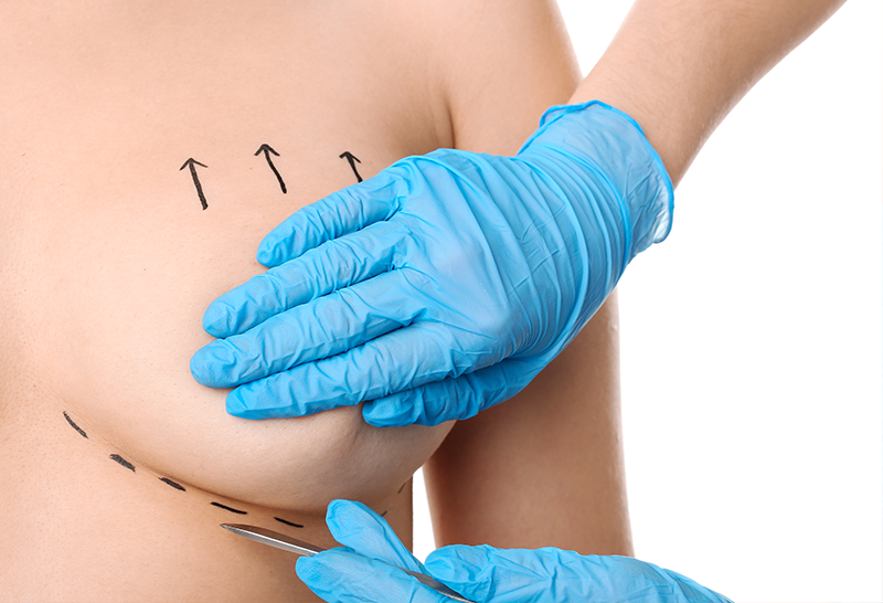 Breast Lifting Surgery (Mastopexy)